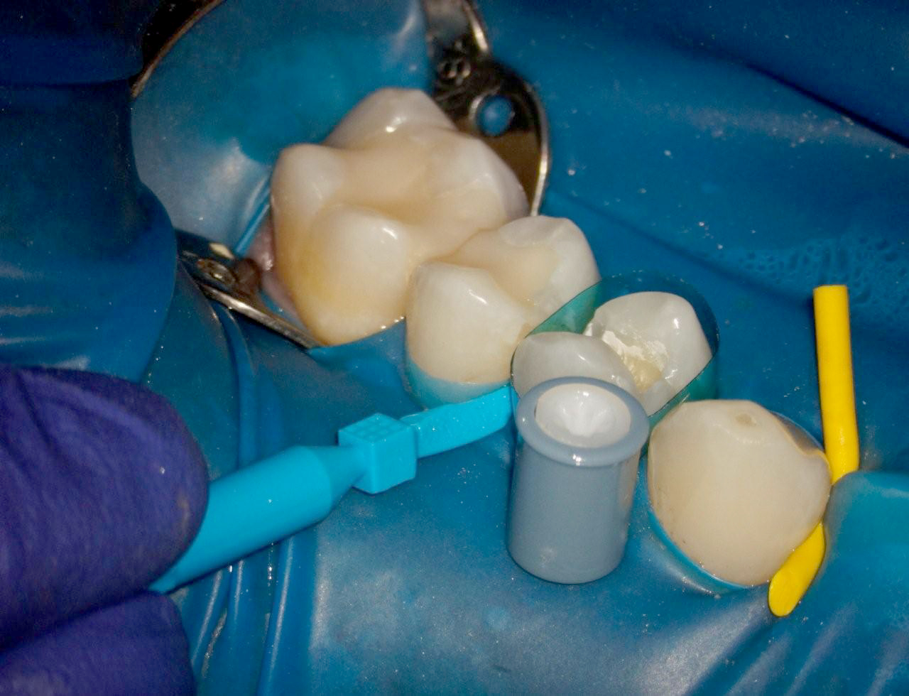 Wedge Wands® Kit Garrison Dental